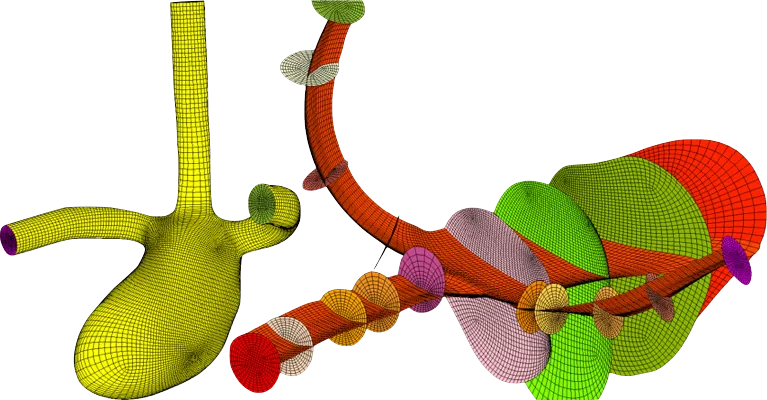 CFD in Biomedical Applications: Structured multi-block grid for an unruptured aneurysm in a cerebral artery, a test case used in CFD Rupture Challenge 2013.