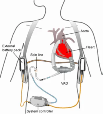Ventricular assist device flow cycle.