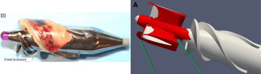 Blood pumps: a. Thrombus growing on the impeller. b. CFD simulation showing the formation of pump thrombosis.